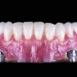 The Differences Between Cheap Dental Implants And Premium Ones
