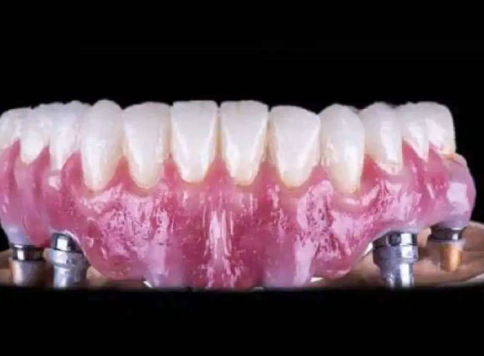 The Differences Between Cheap Dental Implants And Premium Ones